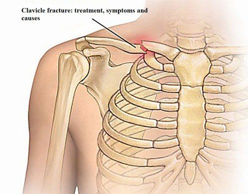 Gãy Xương Vai Có Cần Bó Bột Không? Hướng Dẫn Chi Tiết