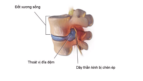 
Bệnh nhân thoát vị đĩa đệm không nên bê vác nặng 