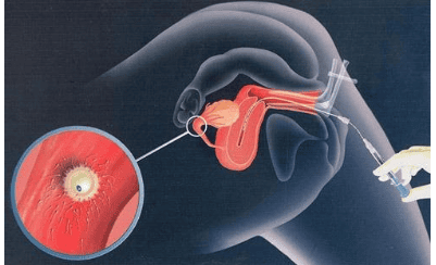 
Thụ tinh trong ống nghiệm (IVF) có chi phí khá cao khi thực hiện
