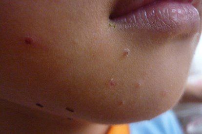 Molluscum contagiosum: Causes, symptoms and treatment