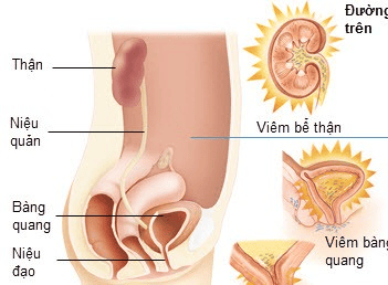 Viêm đường tiểu nhẹ khi mang thai phải làm sao?