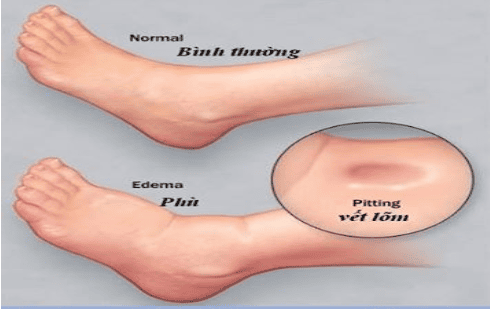 Edema: Causes and symptoms of disease