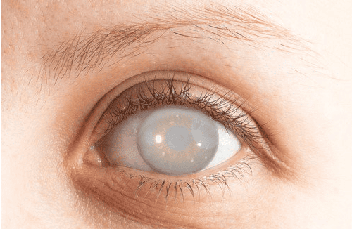 Mắt có vấn đề liệu phải bị đục thủy tinh thể không?