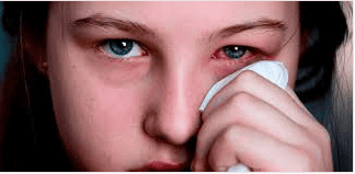 Burns of the eye: Causes, classification and characteristics of damage