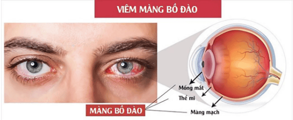 Viêm màng bồ đào: Nguyên nhân, triệu chứng và cách điều trị hiệu quả