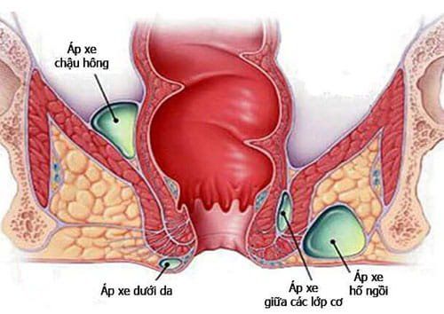 Trẻ 25 ngày tuổi bị áp xe hậu môn điều trị thế nào?