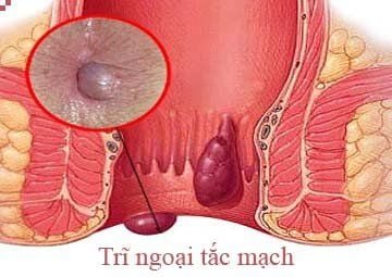 What is hemorrhoid occlusion? How is the treatment?