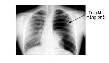 Why is there air in the pleura? Is the X-ray diagnosis accurate?