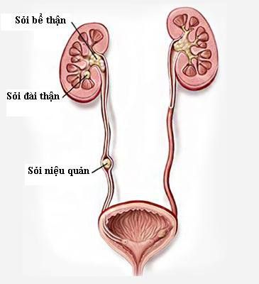 
Những người có tiền sử mổ sỏi thận tăng nguy cơ có dị vật trong bàng quang
