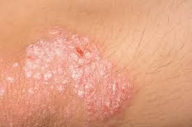 Pictures of plaque psoriasis, pustular psoriasis