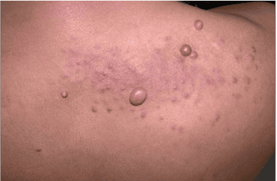 
Piloleiomyoma thể nhiều thương tổn
