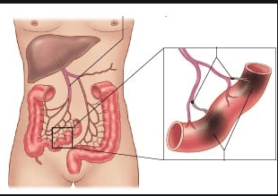 
Hình ảnh nhồi máu động mạch mạc treo do huyết khối
