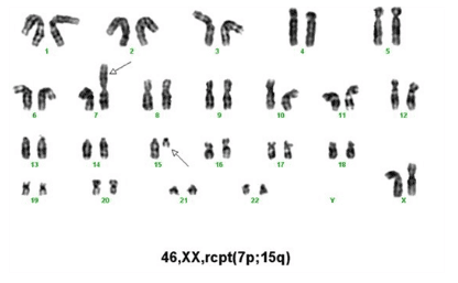 What is Karyotype Test? Application in the treatment of infertility