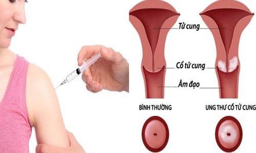 Pap test and cervical cancer