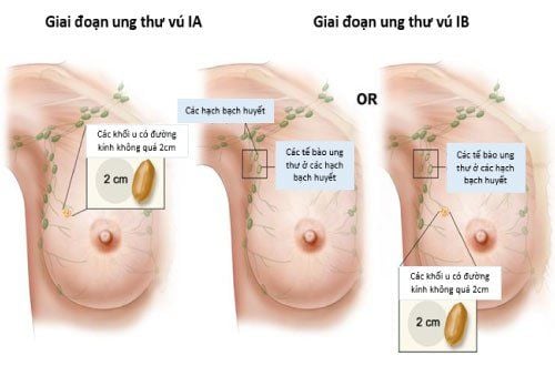 
Hình ảnh mô tả giai đoạn ung thư vú
