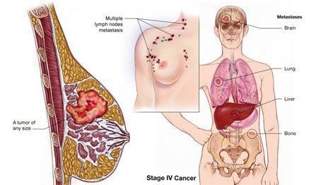 
ung thư vú giai đoạn cuối di căn lên não
