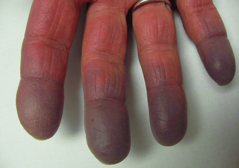 Mixed Connective Tissue Disease: Causes, Symptoms 