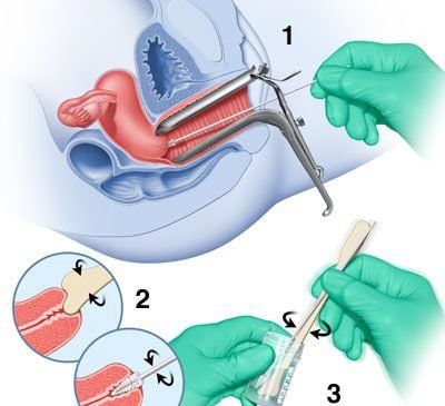 Tế bào biểu mô bất thường, tế bào gai không điển hình có nghĩa là gì?