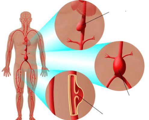 
Phồng động mạch chủ ngực gây chèn ép tim
