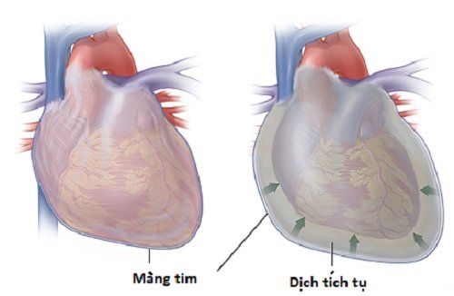 Emergency cardiac tamponade