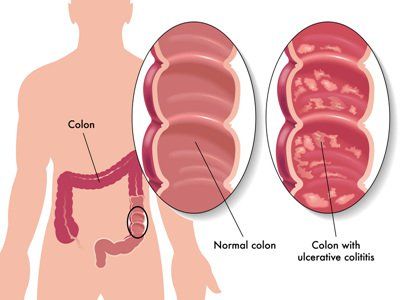 
Bệnh Crohn là tình trạng viêm hoặc loét ống tiêu hóa mãn tính, hay còn gọi là ruột/đại tràng
