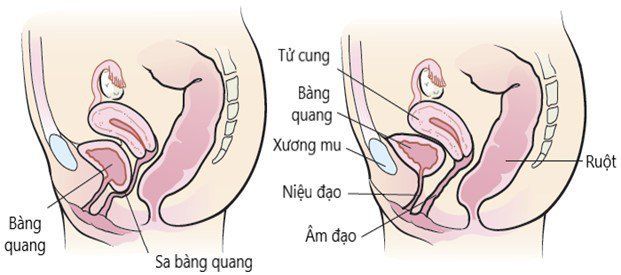 Sa Bàng Quang Tử Cung: Nguyên Nhân, Triệu Chứng và Phương Pháp Điều Trị Hiệu Quả