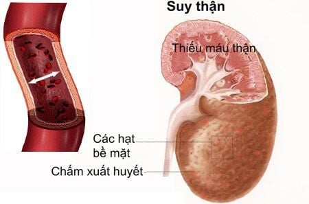 Common renal vascular diseases