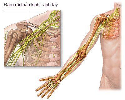 
Đám rối thần kinh cánh tay là một vị trí có thể thực hiện phong bế thần kinh
