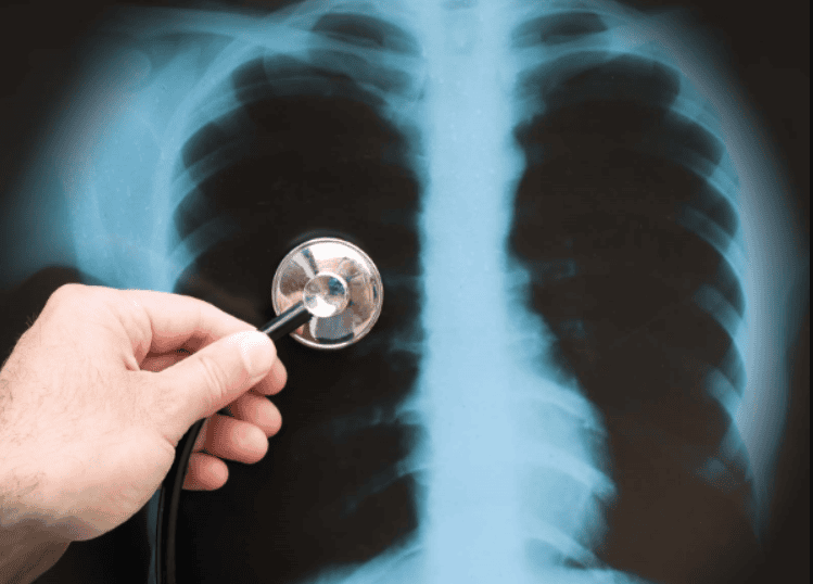 Chest X-ray to diagnose pulmonary embolism | Vinmec