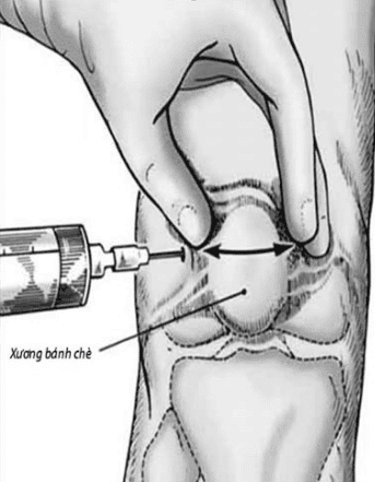 
Tiêm corticoid vào khớp
