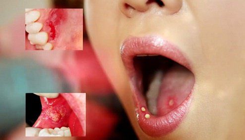 Xuất hiện cục máu trên lưỡi và môi khi ăn là bệnh gì?
