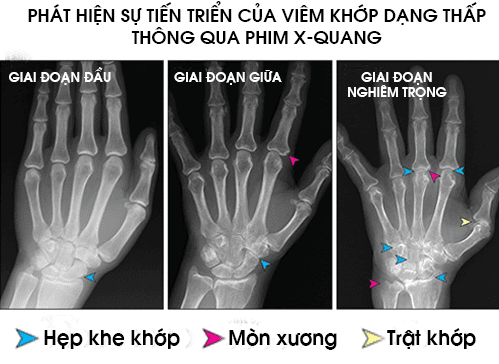 Viêm khớp dạng thấp X-quang: Chẩn đoán và điều trị hiệu quả