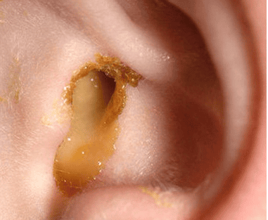 Viêm tai giữa mạn tính thủng màng nhĩ có cần thiết phải vá màng nhĩ không?