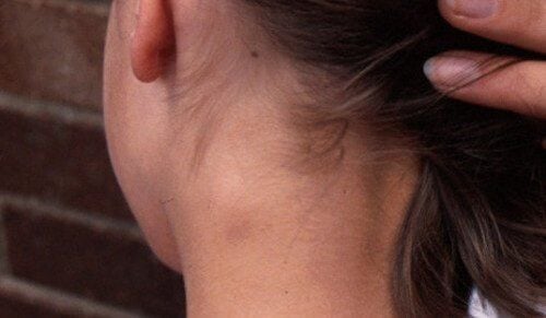 
Swollen neck lymph nodes are a very common symptom and often occur when we have diseases related to the throat area.
