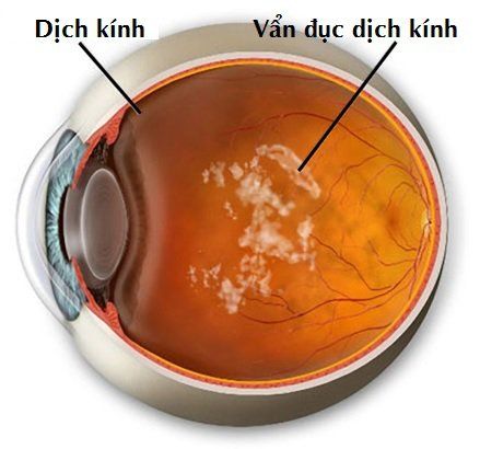 Bị vẩn đục dịch kính có tự hết không?