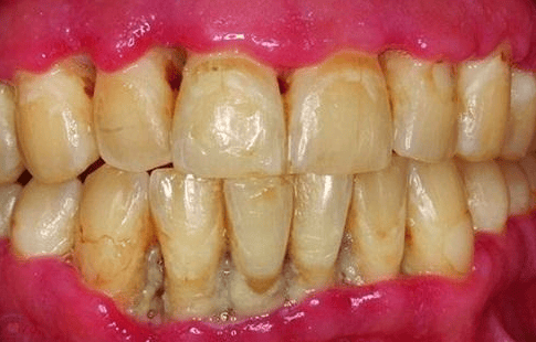 Periodontitis associated with smoking increases the risk of ulcerative colitis