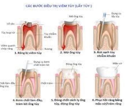 
Các bước điều trị viêm tủy
