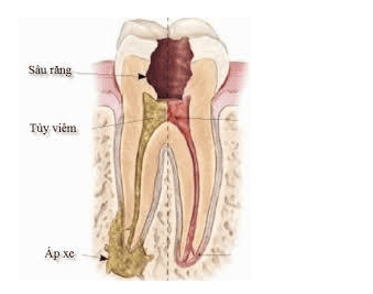 
Các biến chứng của răng sâu vào tủy
