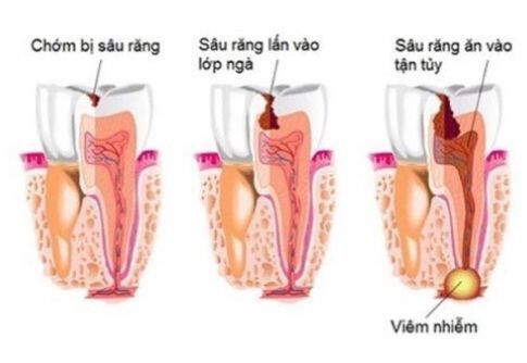 
Khi răng sâu vào tủy, dấu hiệu điển hình là răng đau
