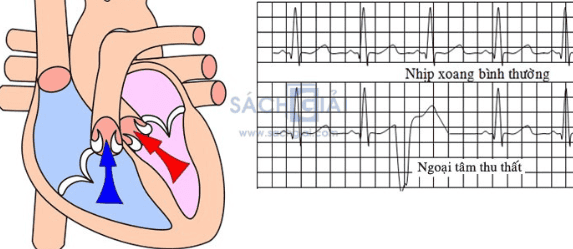 4. Chẩn Đoán Ngoại Tâm Thu Thất