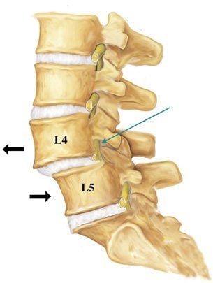 Hở eo đốt sống: Những điều cần biết