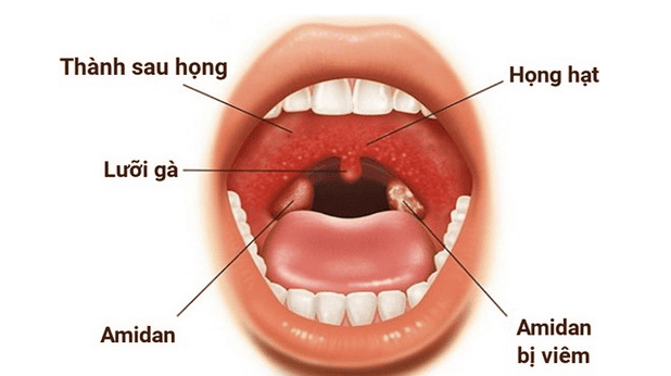 Polyp Họng: Triệu Chứng, Nguyên Nhân và Cách Điều Trị Hiệu Quả