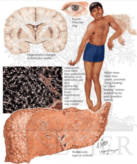 1. Tổng quan về bệnh Wilson