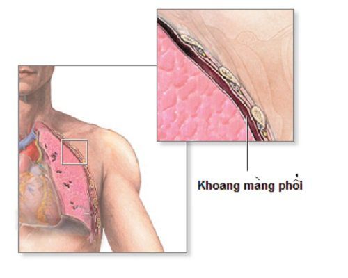 
Trường hợp mủ trong khoang màng phổi chống chỉ định với mổ nội soi
