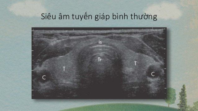 Siêu âm tuyến giáp: Phương pháp chẩn đoán an toàn và hiệu quả