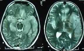 
Chấn đoán u não ở người lớn bằng cách chụp CT hoặc MRI
