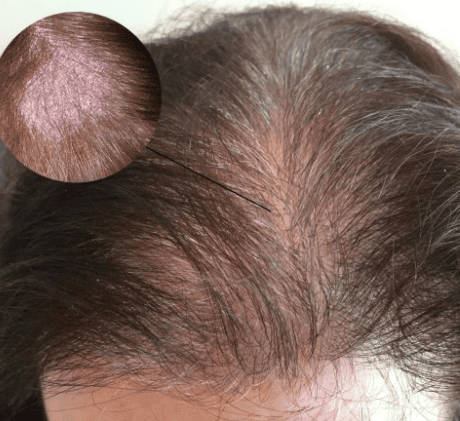 How is scalp psoriasis treated?