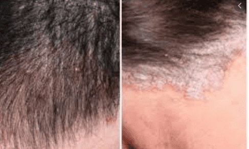 Note when treating scalp psoriasis at home