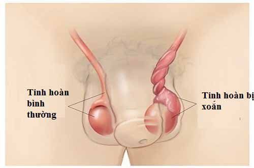 
Xoắn tinh hoàn gây sốt cao, nhất là về đêm ở trẻ
