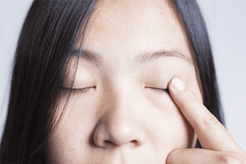 Epicanthus plastic surgery solves the problem of eyelashes rubbing against the cornea